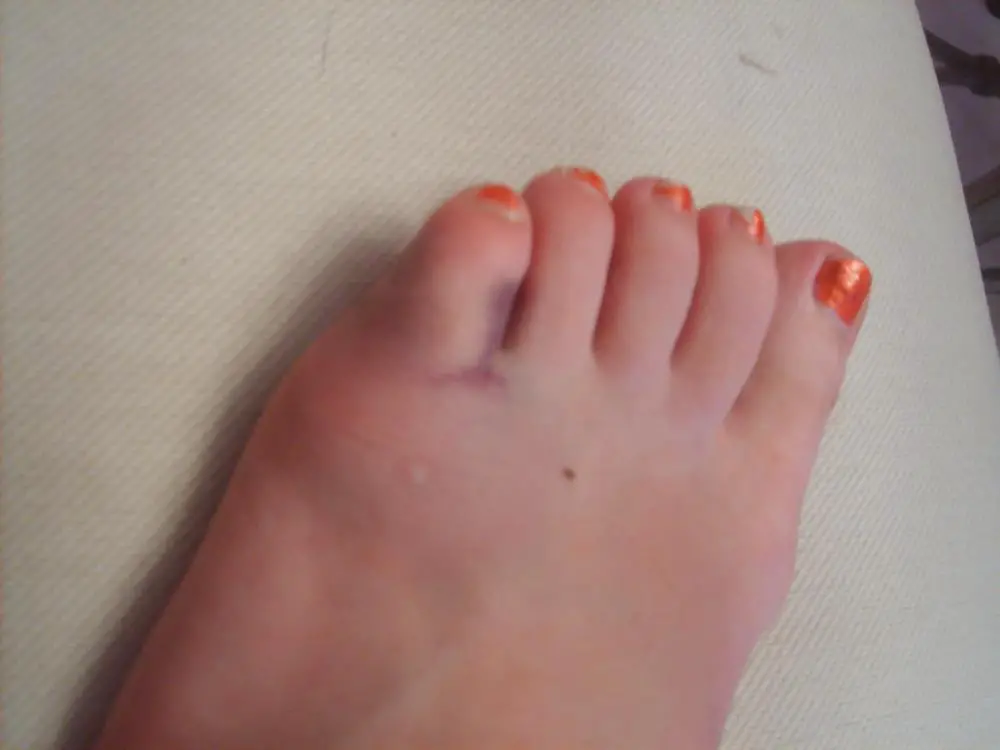 Broken Toe: Symptoms, Causes, Diagnosis, Treatment, and More - wide 9