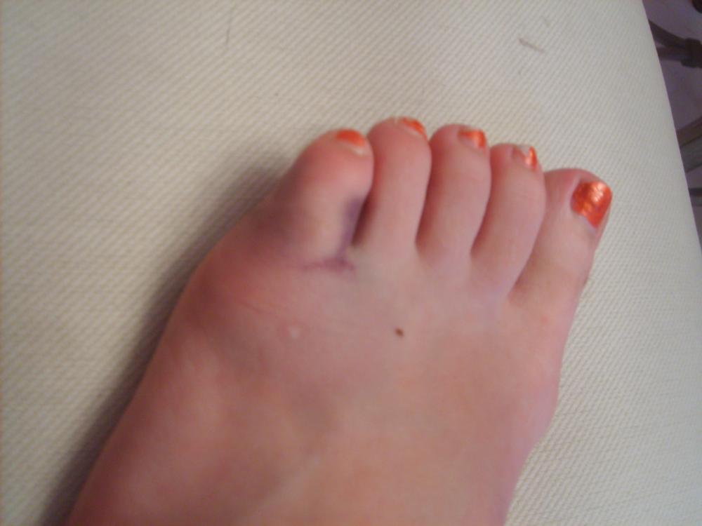 broken toe. How To Treat A Broken Baby Toe